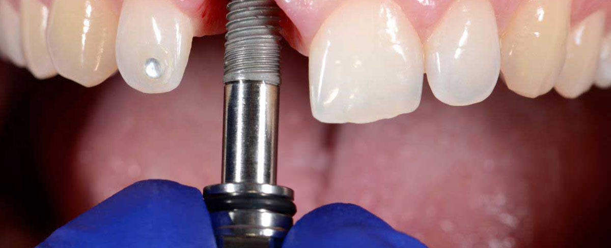 Dental Implant Cost